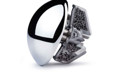 Northtowns Ambulatory Surgery Center Becomes 2nd Site in the World to Perform Surgery Using the OsseoFit™ Stemless Shoulder System